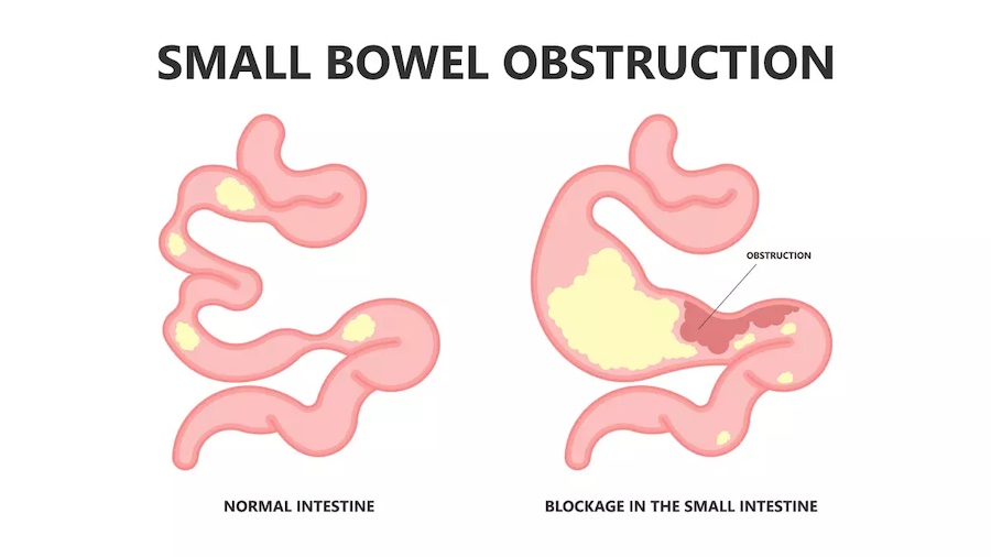 Bowel Obstruction